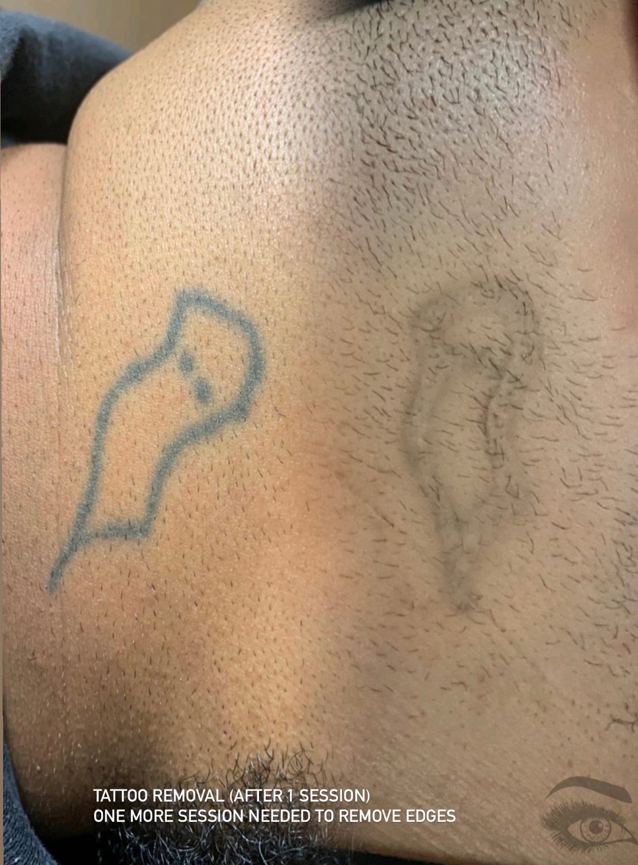 Laser Tattoo Removal with PicoSure Laser Treatment - Epilium & Skin
